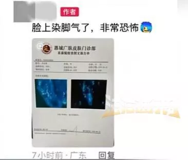 男子健身后脸上染"脚气",直呼太恐怖!多人曾中招